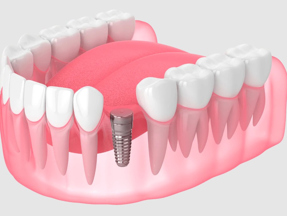 види імплантації зубів